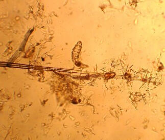 demodex
